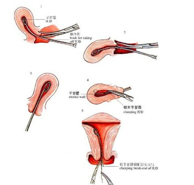 生过孩子后上环,生完小孩上环后要注意哪些