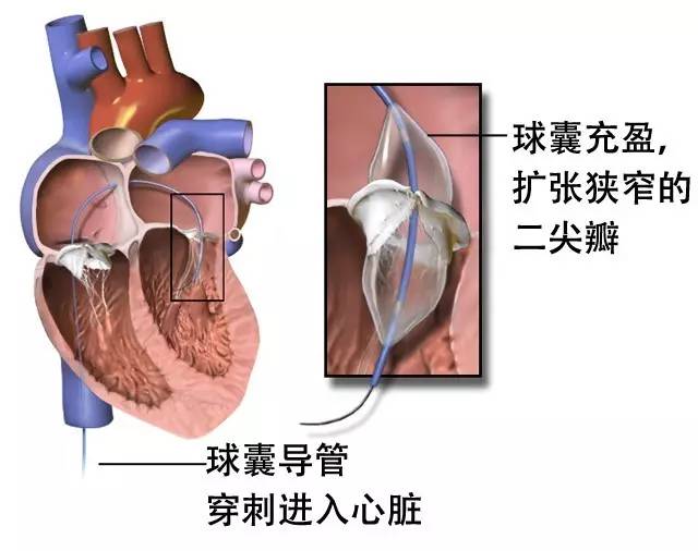 干货丨“心脏阀门”二尖瓣出故障了怎么办？