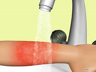 烧伤的急救方法,眼化学烧伤急救