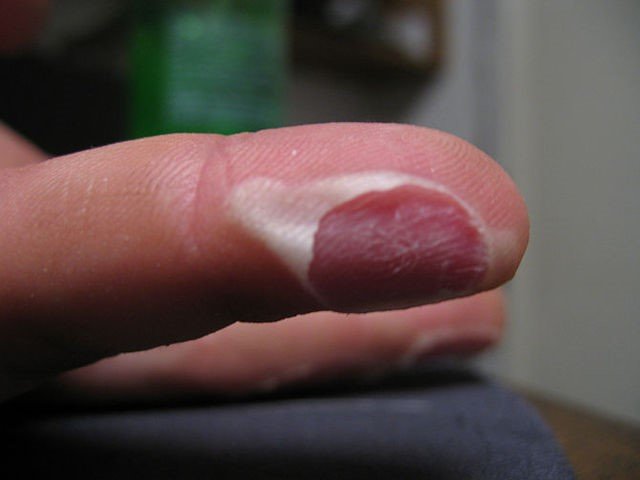 烧伤的急救方法,眼化学烧伤急救