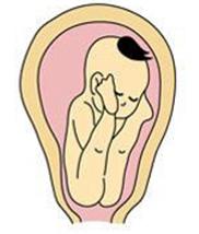臀位宝宝成功顺产,固执的妈妈断送了孩子的生命
