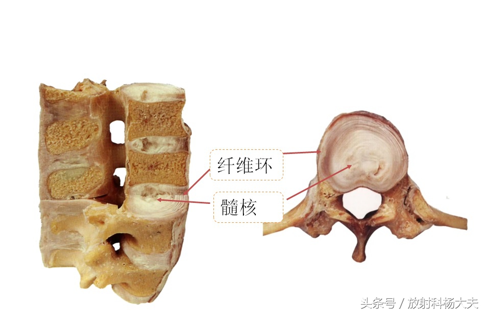 除了腰间盘突出其它哪儿都不突出,椎间盘膨出和脱出的区别