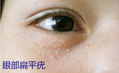 眼睛上边有个小颗粒,眼睛上有个米粒大小的颗粒