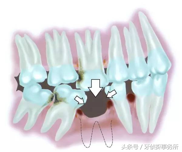 吃肉老是塞牙怎么彻底解决,吃肉塞牙时间长了会怎样