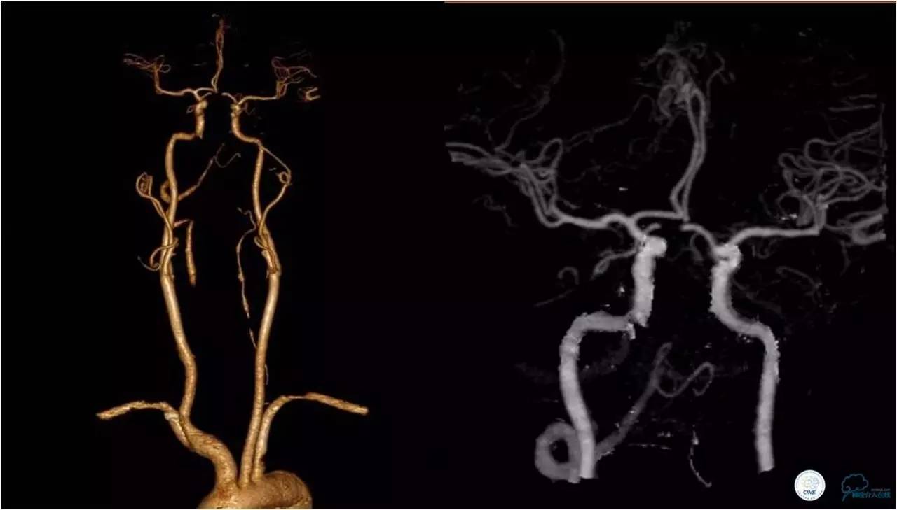 后循环系统梗死,后循环梗死