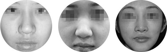 鼻子不好看能改善吗,大鼻子不好看怎么办