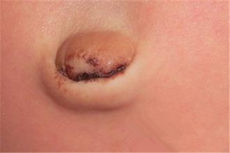 孕妇肚脐黑色污垢怎么清理,新生儿肚脐每天都要清理吗