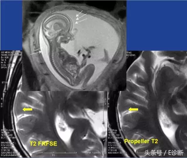 磁共振伪影及解决方案,e系列诊断