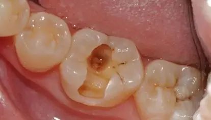 蛀牙怎样才能控制住不再有蛀牙,蛀牙怎么避免更严重