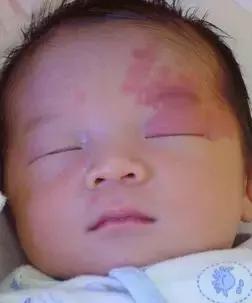 白色胎记的图片,胎记知多少基础篇