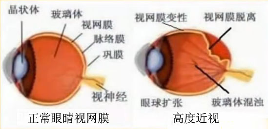 家长近视对孩子的影响,孩子近视后家长不重视的后果