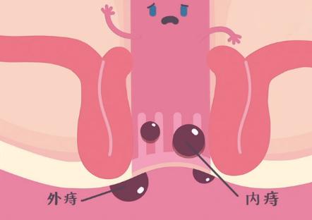 痔疮不用药能自愈么,解决痔疮顽疾有方法