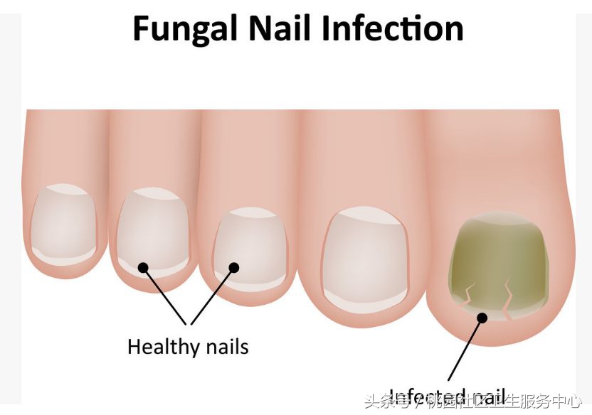 从脚看健康程度图解,从脚指甲颜色看身体健康