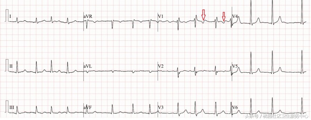 继发性stt异常是什么意思,心电图继发性st-t改变是什么意思