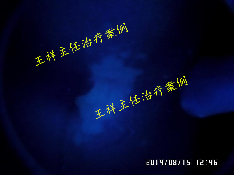 白癜风黑色素种植效果好吗,黑色素种植治疗白癜风费用