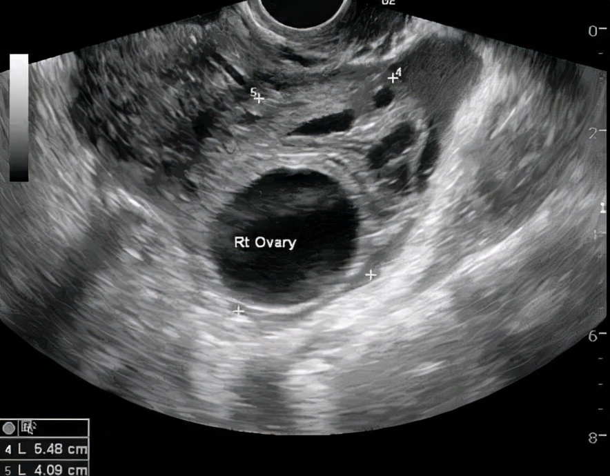 体检发现卵巢囊肿后面复查没有了,月经前体检卵巢囊肿