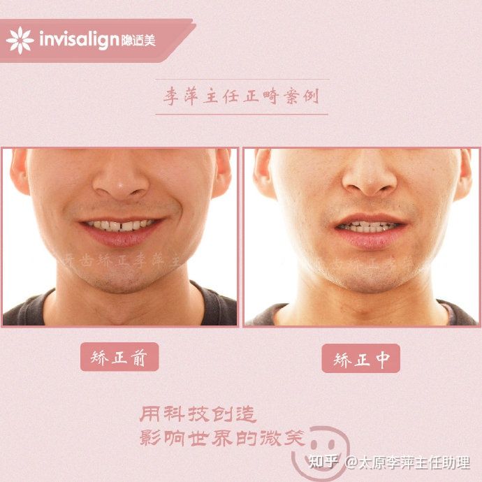 重度拥挤矫正牙齿适合隐形牙套吗,广州成人牙齿矫正推荐隐形牙套