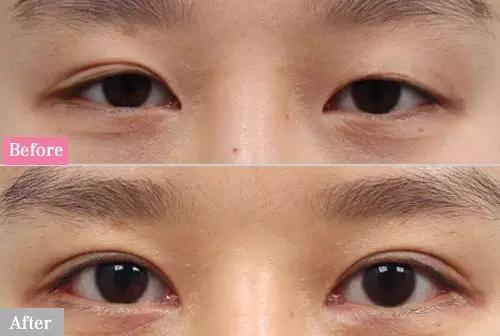 不建议做双眼皮的三种情况,为什么不建议做双眼皮