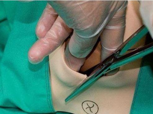 每个孕妇顺产大部分都是侧切吗,为什么孕妇都选择顺产