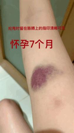 短跑名将张培萌被曝家暴反转,短跑名将张培萌家暴背后