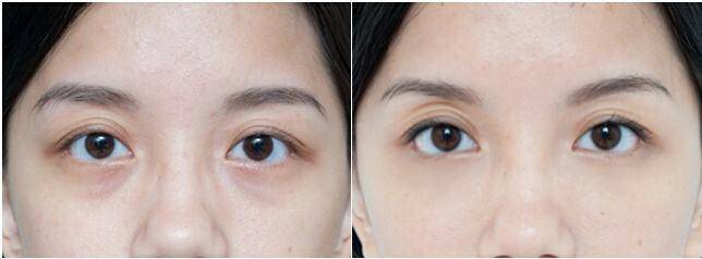 眼霜到底是鸡肋吗,眼霜副作用大吗