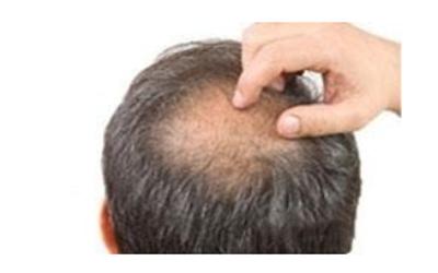 25岁男生脱发是因为肾虚嘛,男的脱发严重脸色也不好是肾虚吗