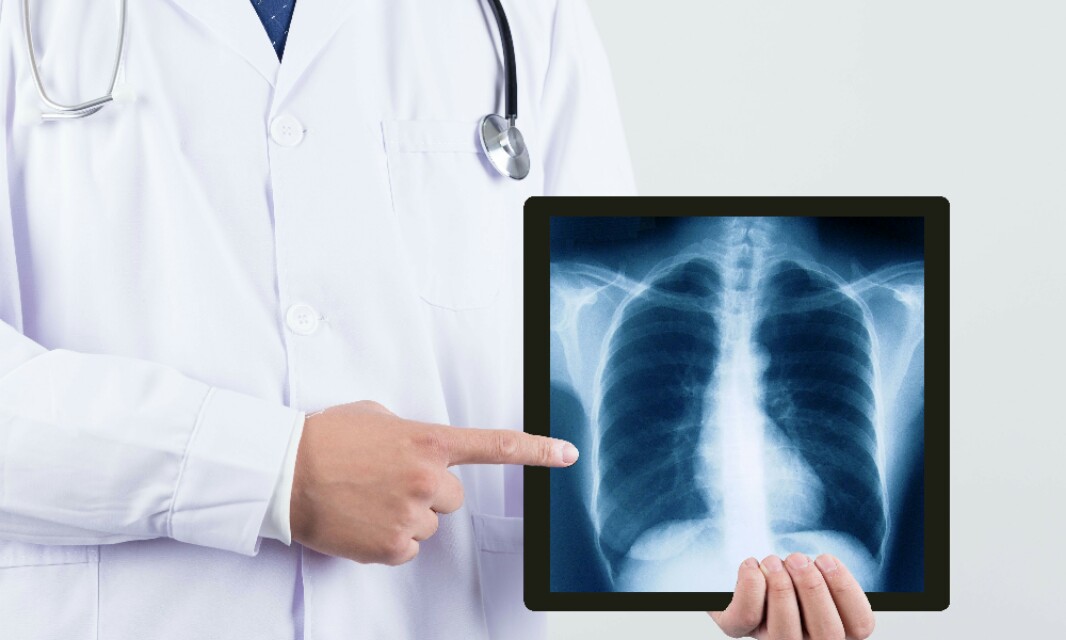 民间高手能治好肺癌吗？没有哪个医生敢随便说治愈、治好肺癌