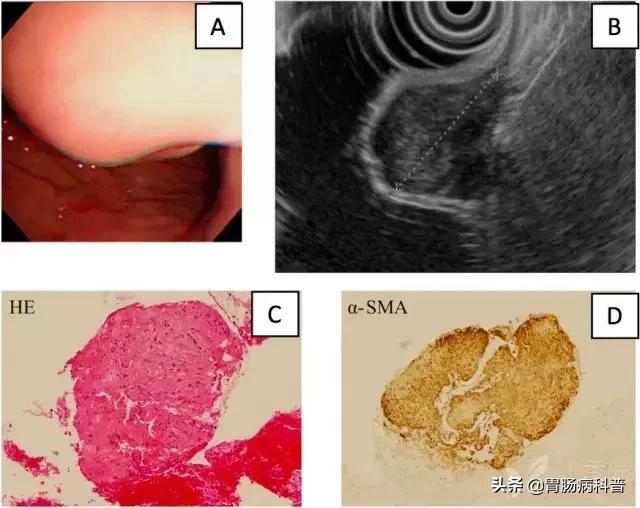 胃癌手术后一年胃镜说胃粘膜隆起,胃镜报告有隆起