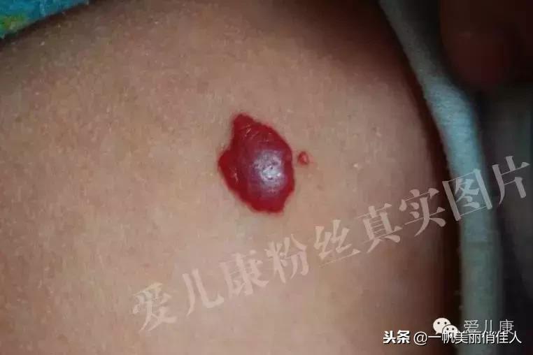 宝宝身上有点小红点,宝宝身上红色胎记但是不凸起