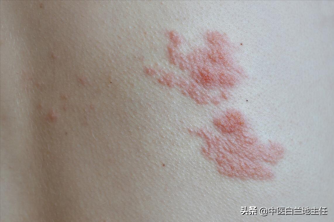 中医治疗疱疹医案,经方治疗带状疱疹医案