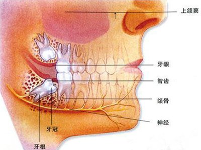 拔了智齿两年了老发炎,智齿发炎到底要不要拔掉