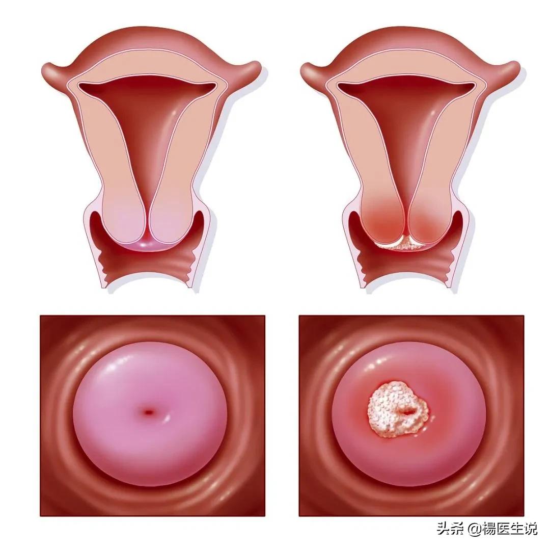 女性两癌筛查多少岁开始,女性两癌筛查多大年龄能查啊