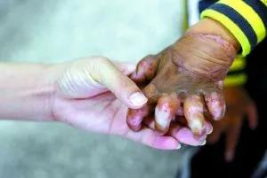 重疾险产品中“Ⅲ度烧伤”的理赔实务及探讨