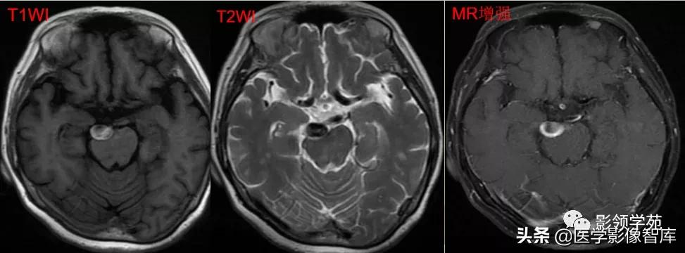 鞍区肿瘤做什么检查得出来,鞍区肿瘤的影像学鉴别