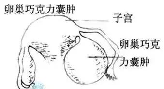 巧克力囊肿手术后一般多久会复发,卵巢巧克力囊肿术后怎么防止复发