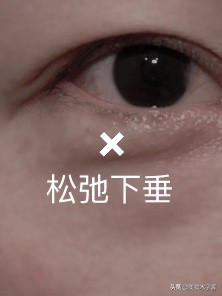 眼周提升方法,眼周提升正确手法