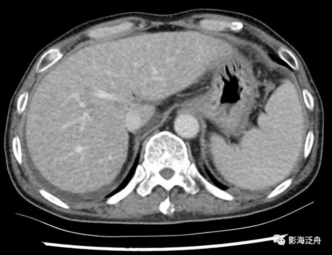 肝脏弥漫性病变严重吗,肝脏弥漫性的病变的症状