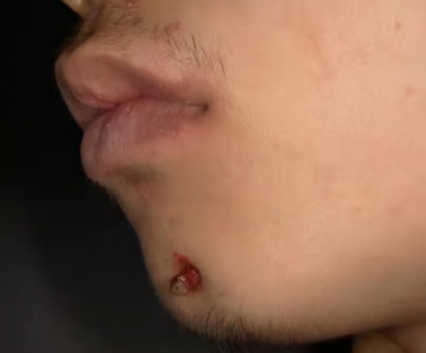 牙齿坏死和下巴长痘有关,下巴长出瘤子