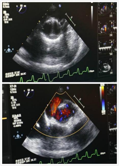 心血管病患者新希望——沈医二院成功完成一例TAVI手术