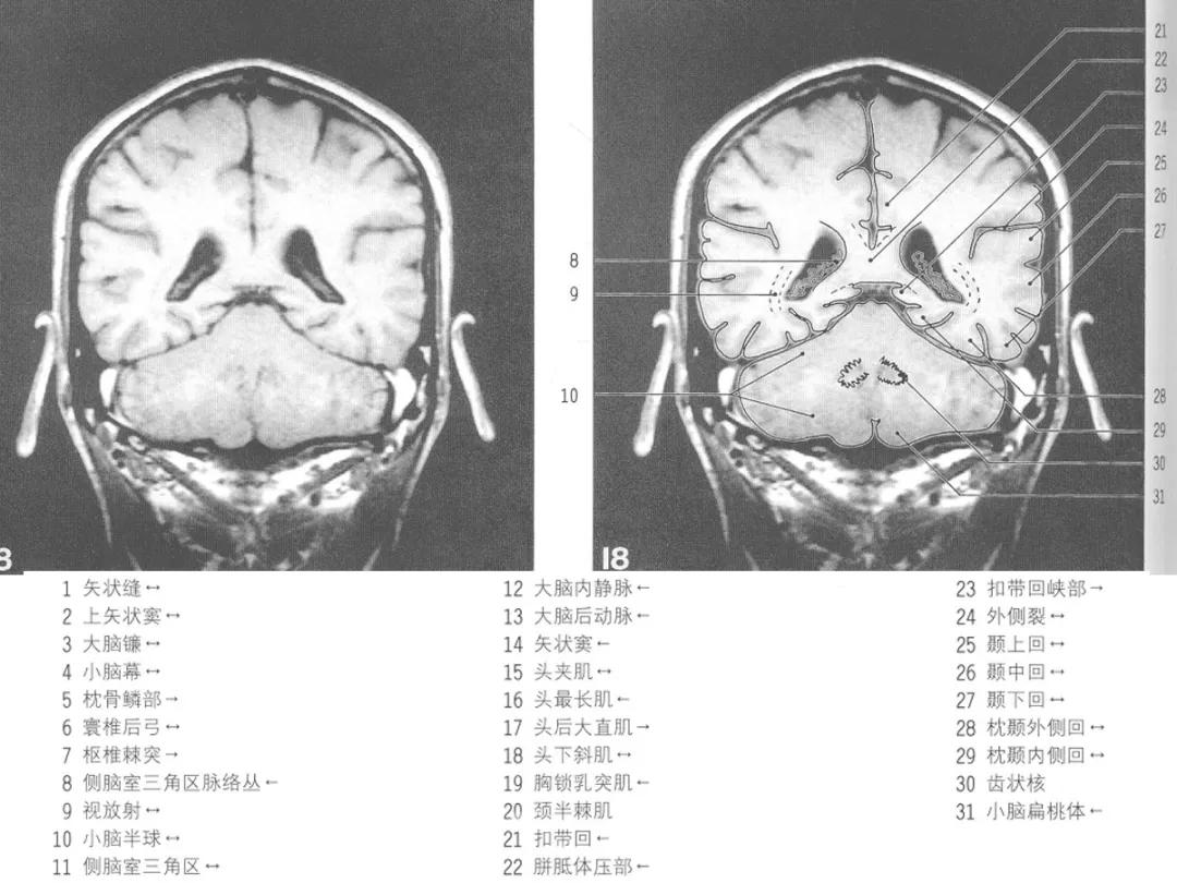 颅脑冠状状切面解剖图,颅脑mr解剖结构图