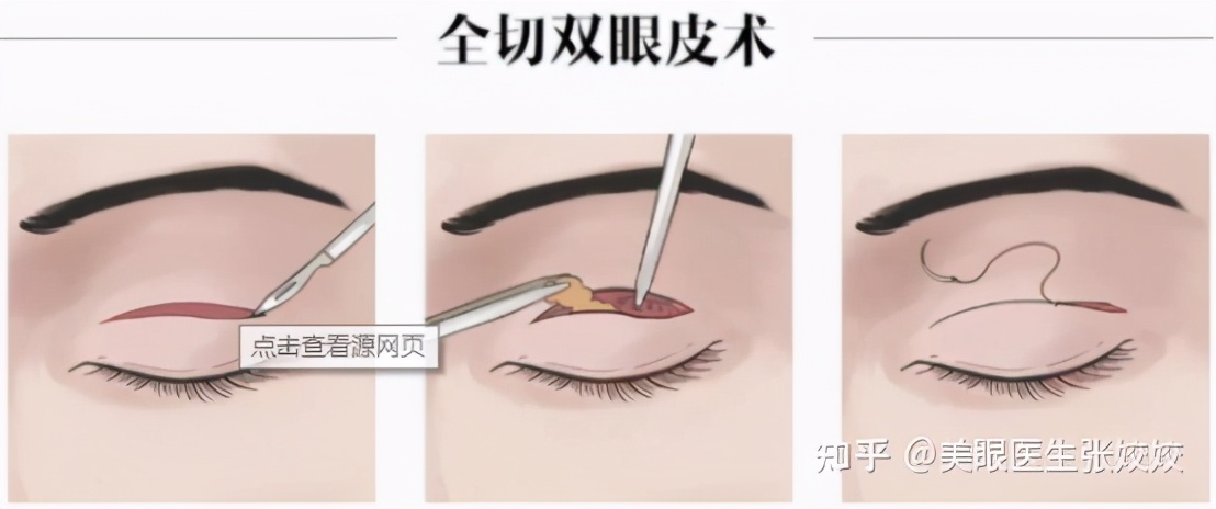 贴了双眼皮贴后的真实效果,贴双眼皮贴容易起翘