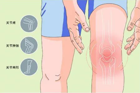 膝关节退行性关节炎怎么治疗,膝关节退行性关节炎缓解方法