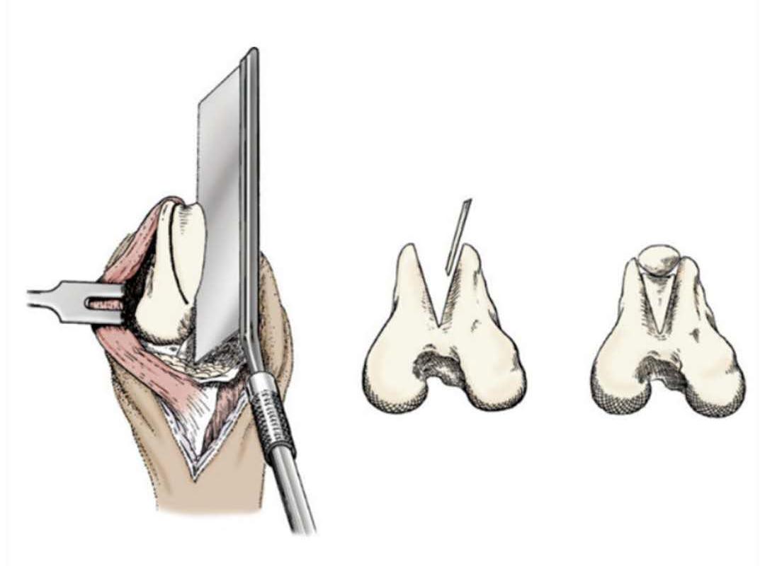 髌骨脱位犬动画,犬跗骨骨折