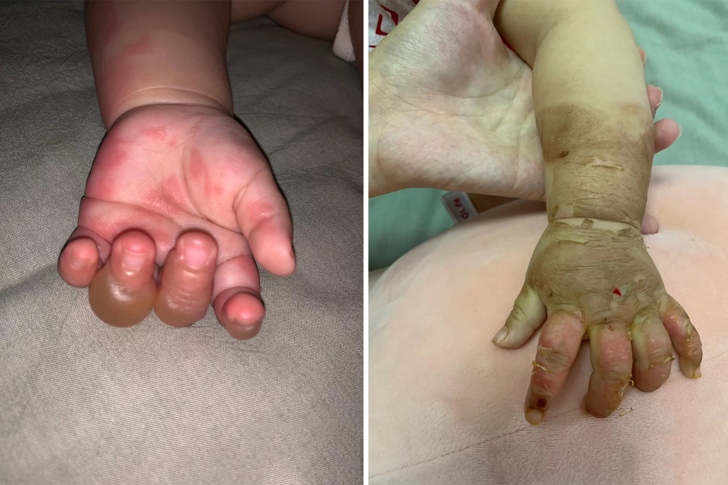 妈妈不小心打翻油锅烫伤孩子,孩子不慎将碗打翻烫伤妈妈