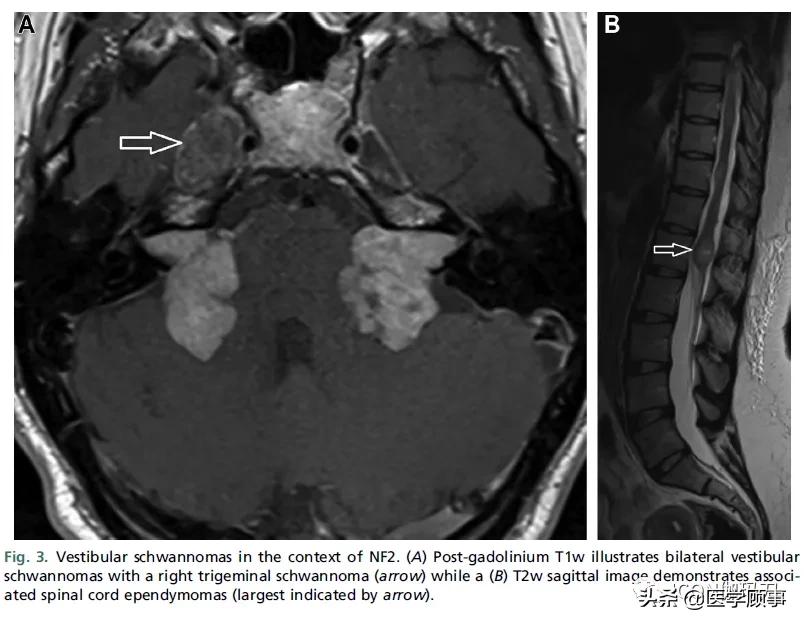 「综述」前庭神经鞘瘤的成像：诊断、监测、和治疗计划