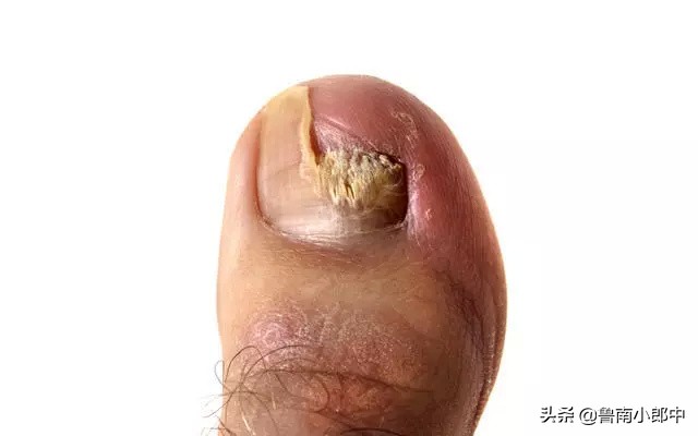 得了灰指甲一个传染俩靠谱吗,得了灰指甲一个传染两个