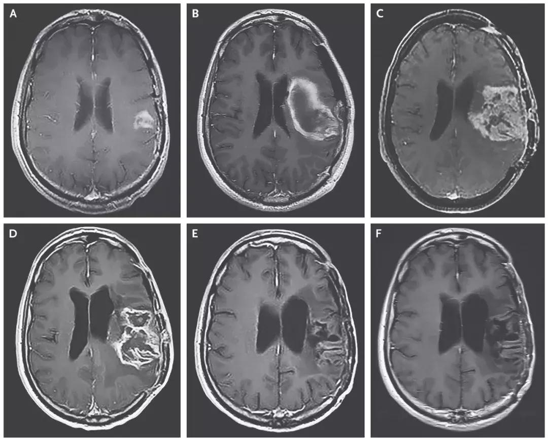 癌症pd1免疫治疗技术,5类癌症病人pdl1免疫治疗效果最好