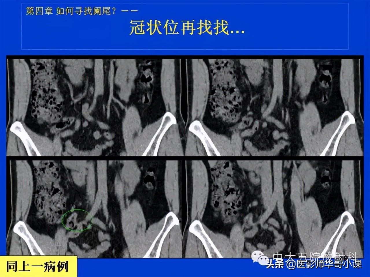 阑尾炎课件,阑尾炎的超声课件