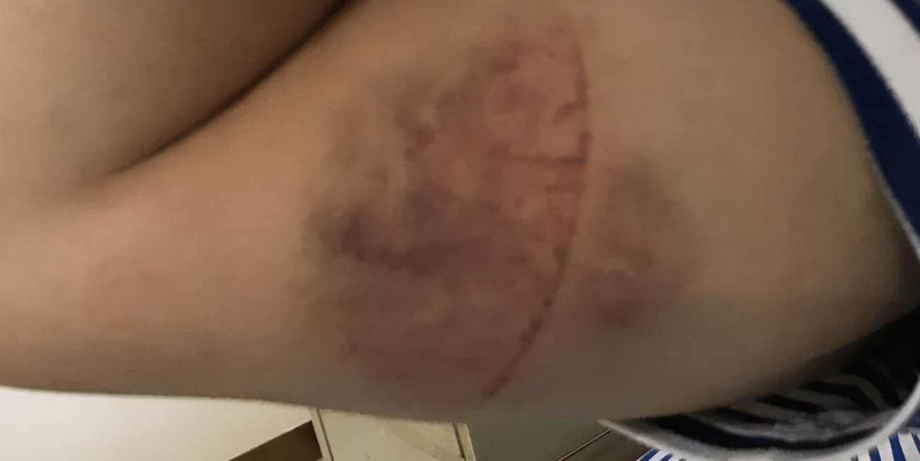 胸口周围发黑怎么办,胸口发黑起皮怎么回事