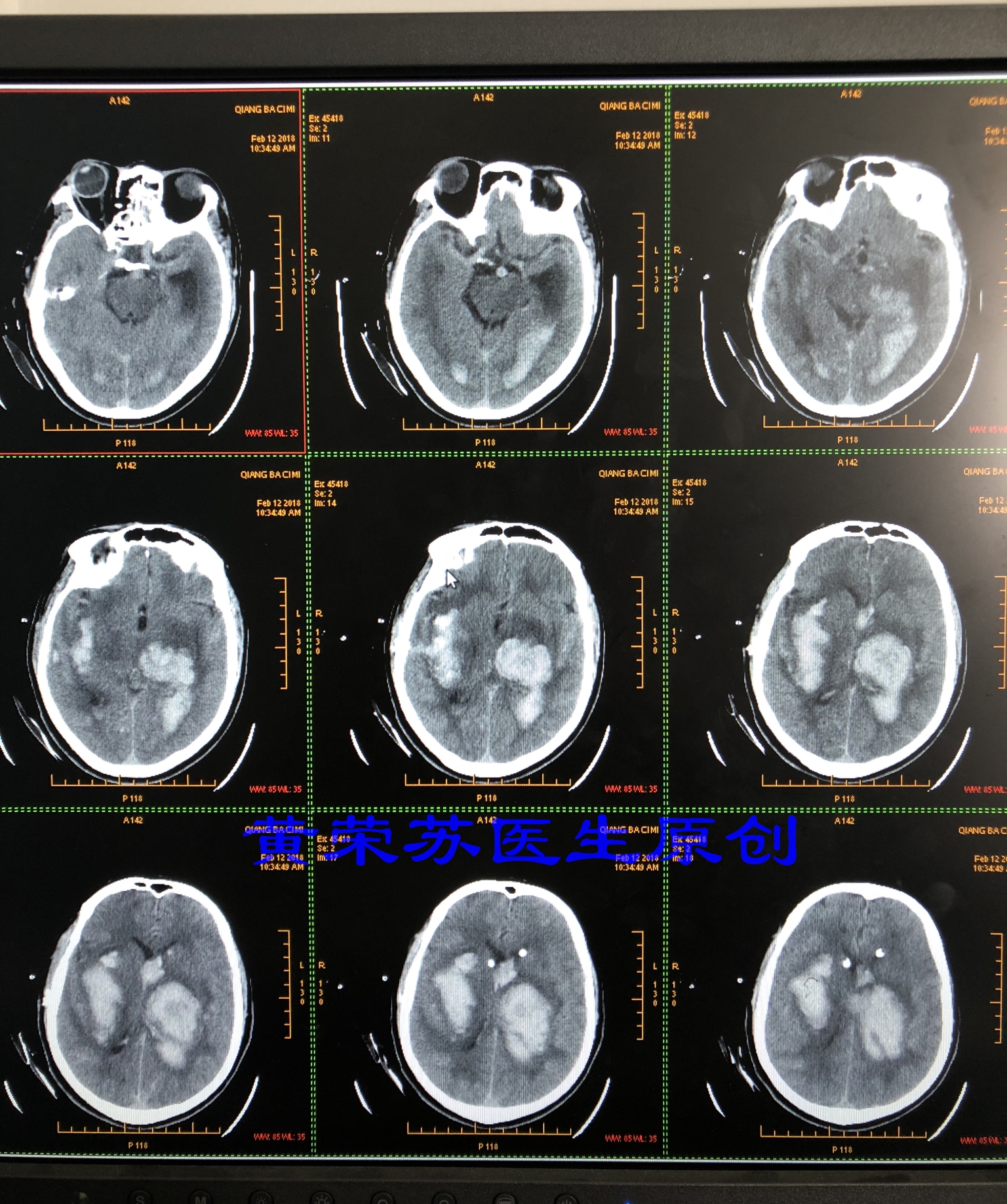 脑出血症状科普动画视频,脑出血的出血部位脑细胞会坏死吗